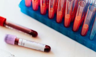 В Беларуси опробуют уникальный онкотест: он по крови определяет более 60 видов опухолей