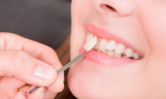 Реставрация при бруксизме: как защитить зубы и виниры?