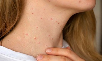 Что делать, если у кого-то в офисе ветрянка, и можно ли заразиться, если уже болел в детстве